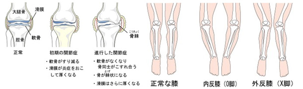 症 関節 変形 膝 性