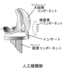 人工膝関節