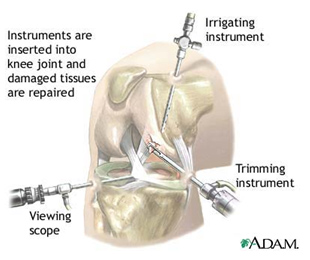 膝関節鏡手術