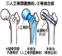 人工骨頭置換術、骨接合術