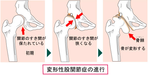 難病 股関節 「変形性股関節症」｜日本整形外科学会 症状・病気をしらべる