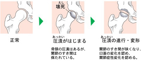 難病 不全 蓋 臼 形成