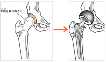 股関節 難病