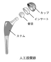 人工股関節